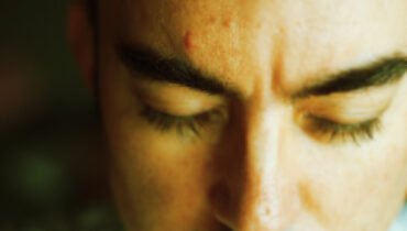 aloe vera para el acne